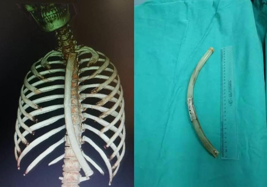 26岁女孩把50cm“仙女管”塞入体内，视频曝光：病态欲望正在蔓延