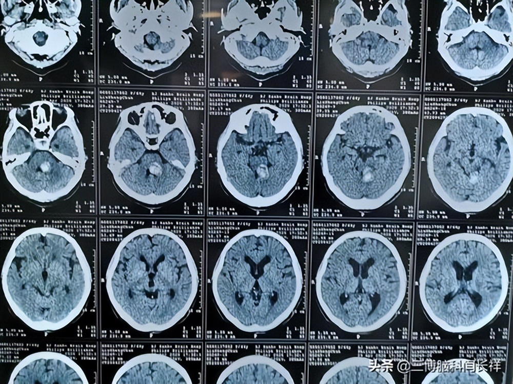 医生在患者清醒下进行开颅,脑子进血开颅手术