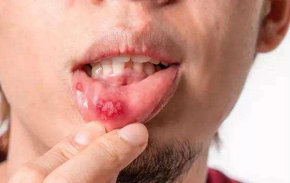 乙肝不能吃哪些肉,乙肝不能吃发物