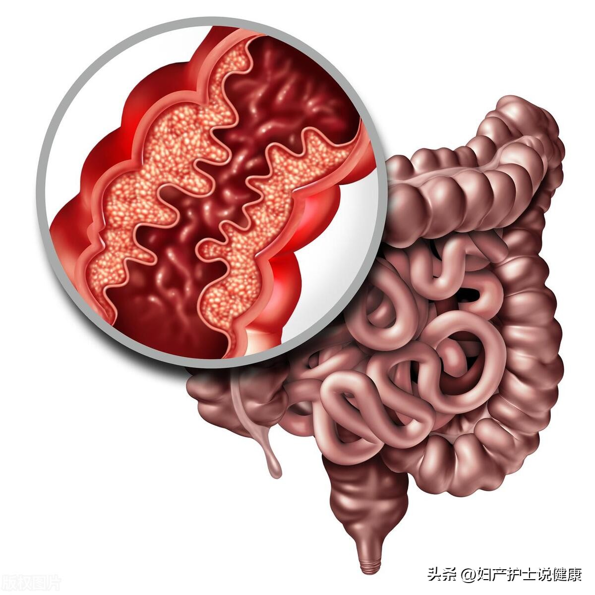 80多岁老太右下腹痛是什么毛病,60岁女人腹部疼痛胀气