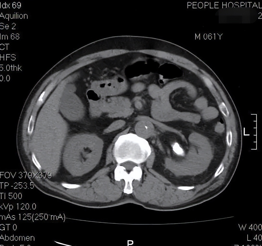 56岁男子肾结石,59岁男子左侧腰部痛以为是肾结石