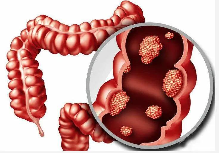直肠癌新辅助疗法放疗效果,直肠癌新辅助化疗法