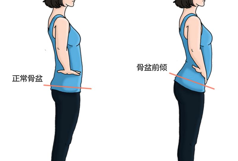 趴在床上腰痛是怎么回事,睡觉腰酸背痛是因为骨盆前倾吗