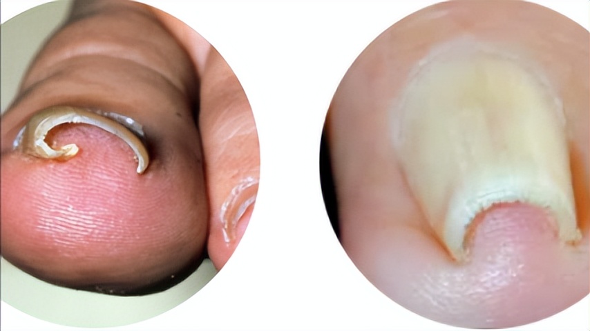 嵌甲疼痛难忍,嵌甲怎么才能有效缓解疼痛