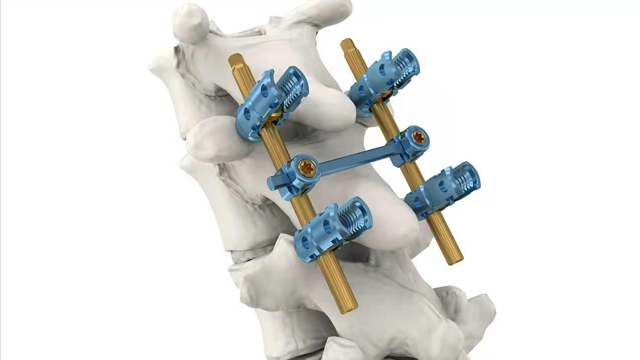 脊柱有钉能做磁共振吗,脊柱手术后有钢丝能照核磁共振吗