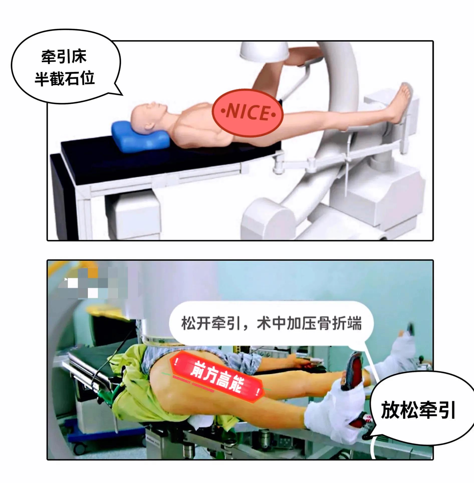 股骨粗隆间骨折内钉技巧图解,股骨粗隆骨折髓内钉操作视频