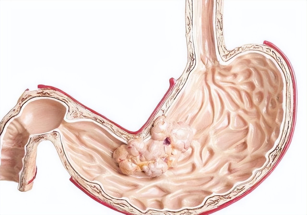 做一次胃镜对胃伤害多大,胃镜多长时间做一次不伤害胃