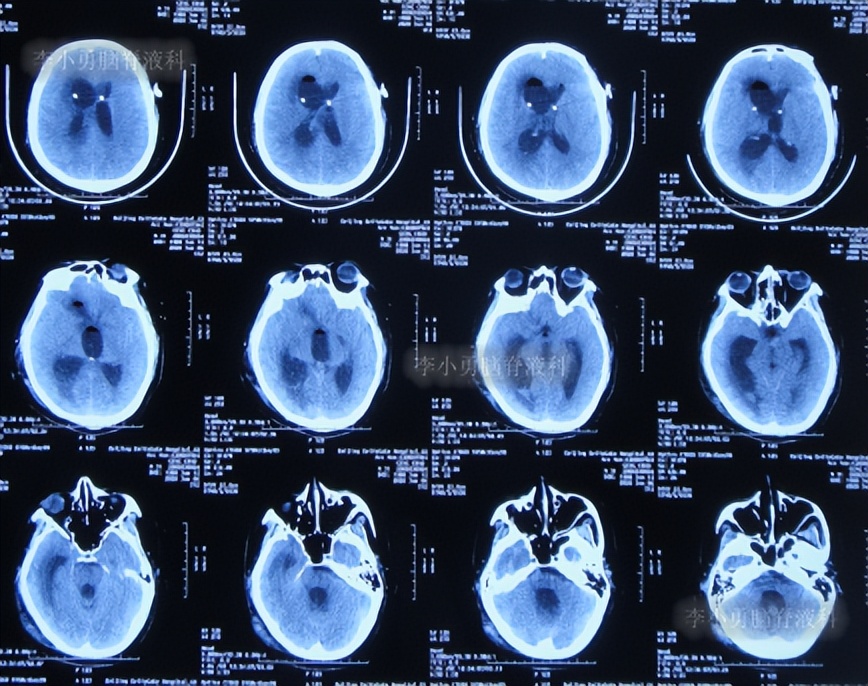 脑积水三脑室造瘘多久能恢复,脑囊虫手术后脑积水