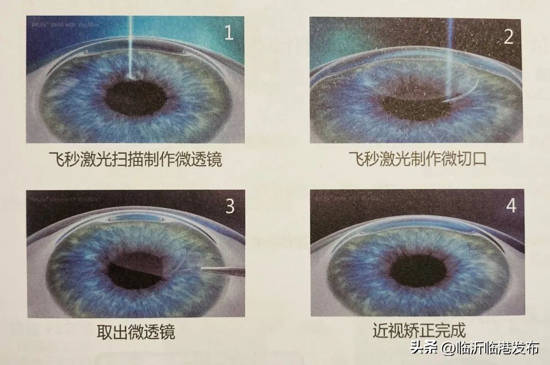 激光手术后视力反弹,激光近视手术做后视力有多少