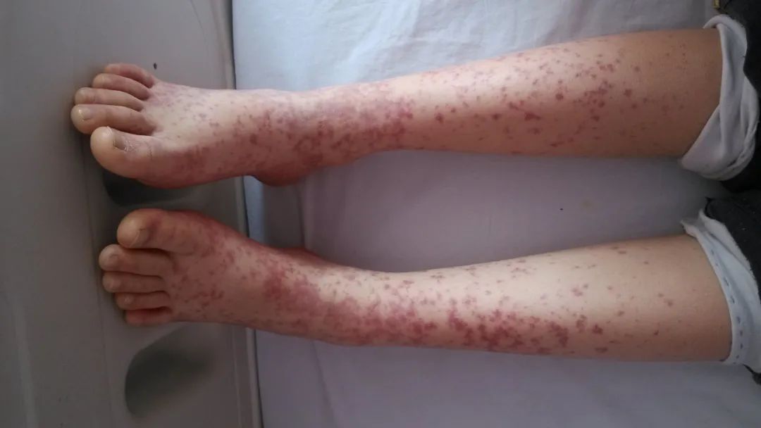 皮疹能完全治愈吗,皮疹可以治愈或者根治吗