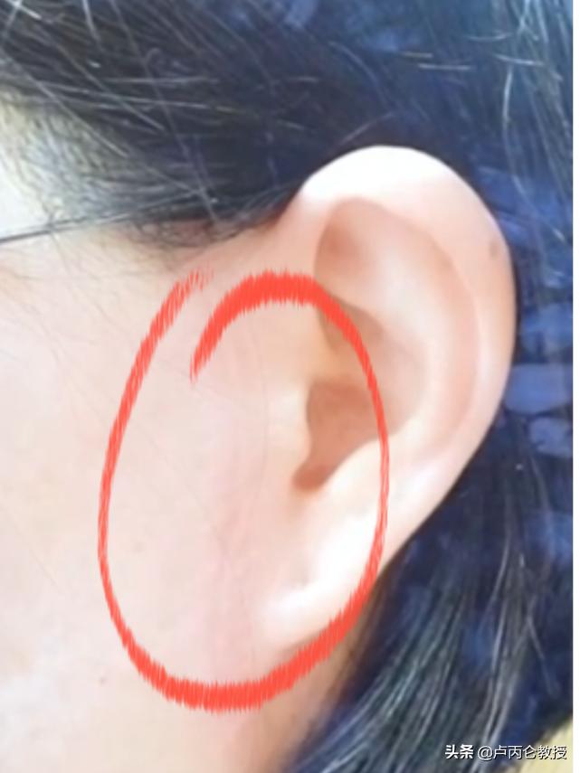 电波拉皮眼部除皱有后遗症吗,做拉皮除皱有风险吗