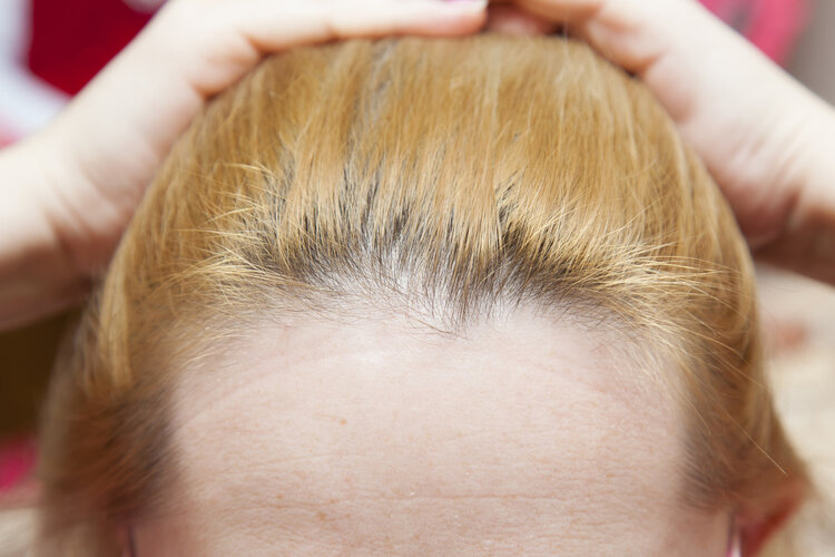 头皮总长疙瘩和脓包是怎么回事,头皮老是长疙瘩有脓包什么原因