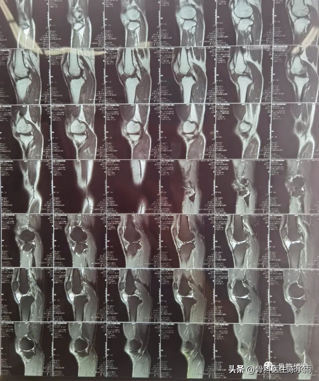 内侧半月板前角囊肿,关节镜下内侧半月板部分切除术