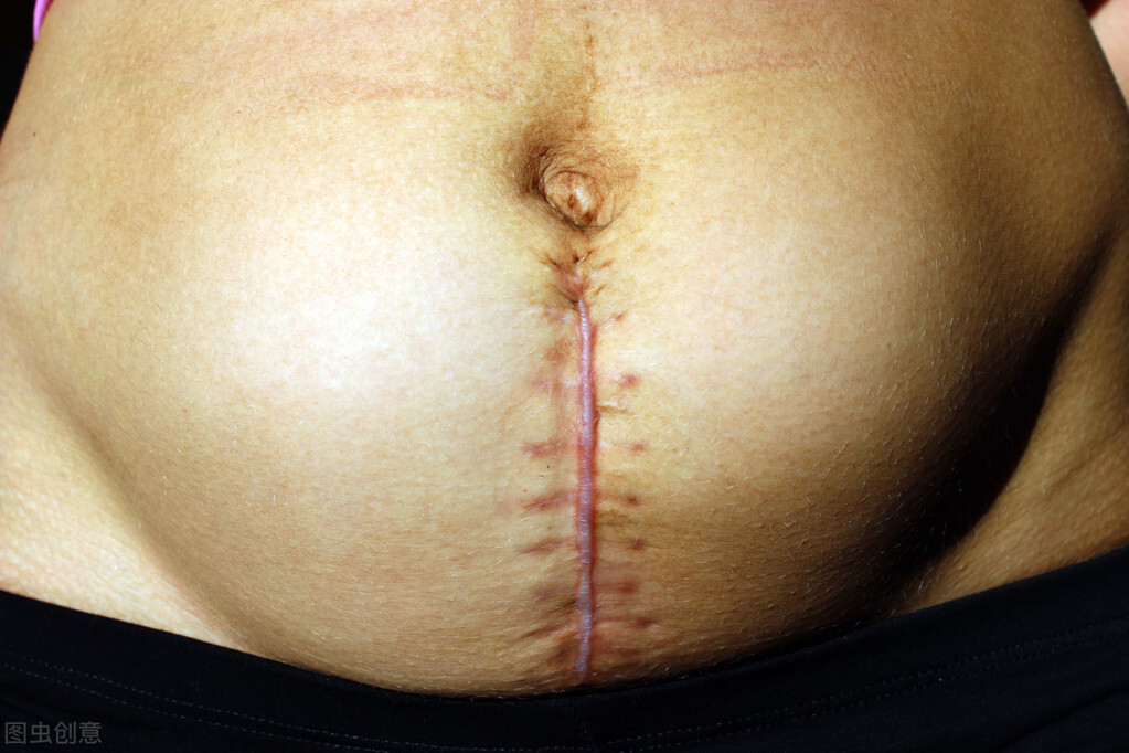 剖腹产再次分娩还是原来的刀口吗,剖腹产后再生是剖还是顺