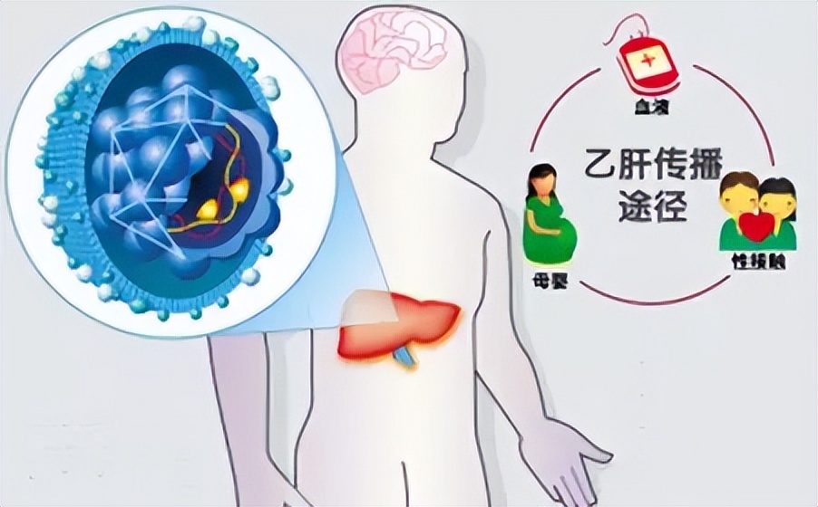 婚检乙肝患者有没有办法快速转阴,婚检时查出有乙肝怎么办