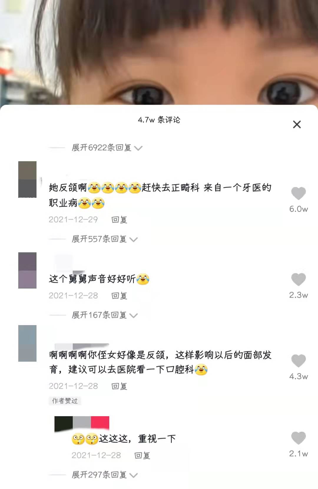 儿童牙齿反颌有什么危害,婴幼儿反颌怎么鉴别