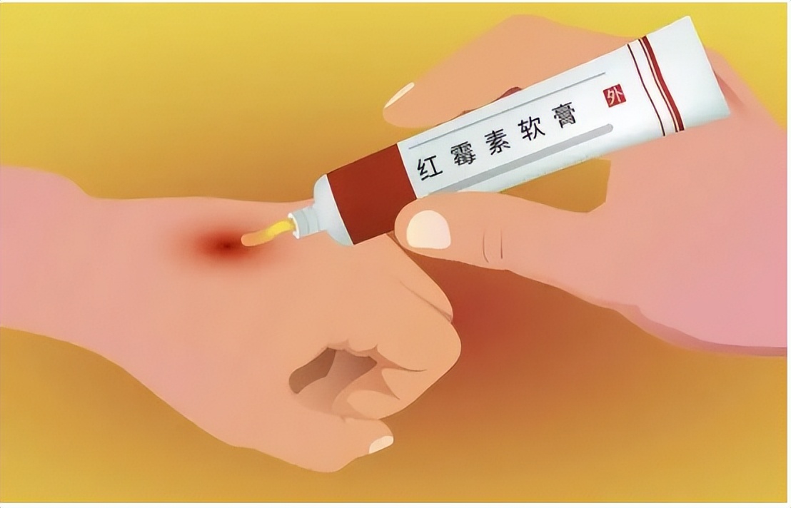 去除老年斑最有效的药膏,用什么药膏治疗老年斑最有效