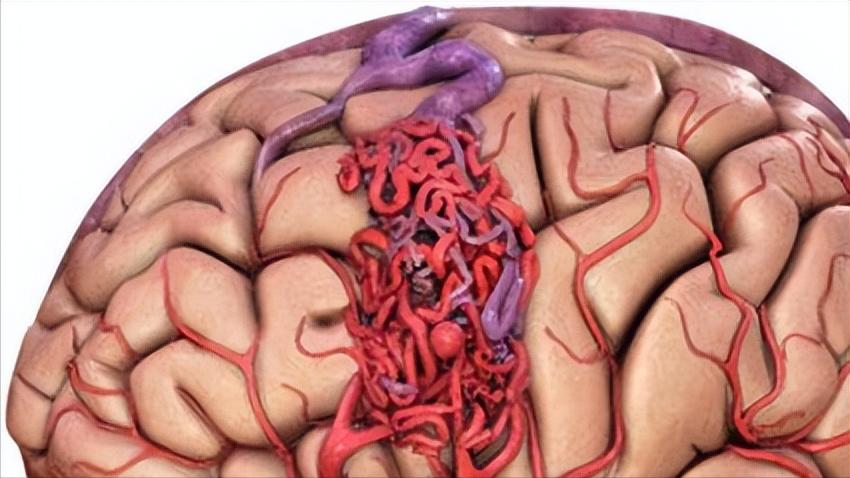 家人突发脑出血咋办？医生教你家庭急救办法，身边有高血压的请看