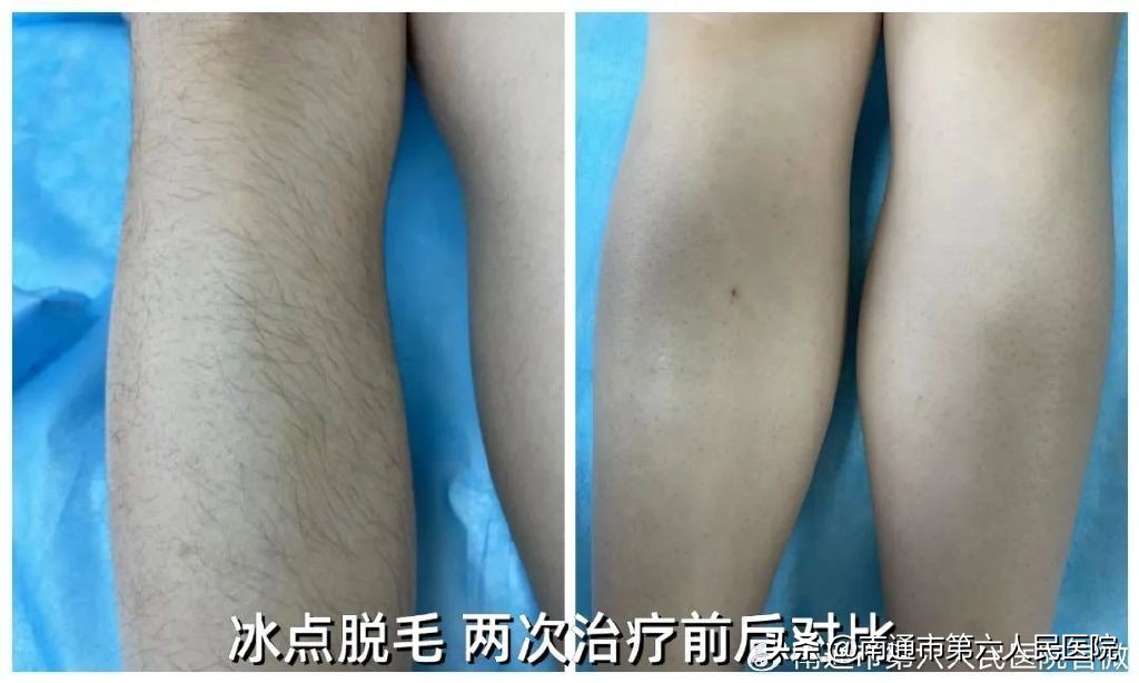 冰点脱毛除唇毛,冰点脱毛能根除体毛吗