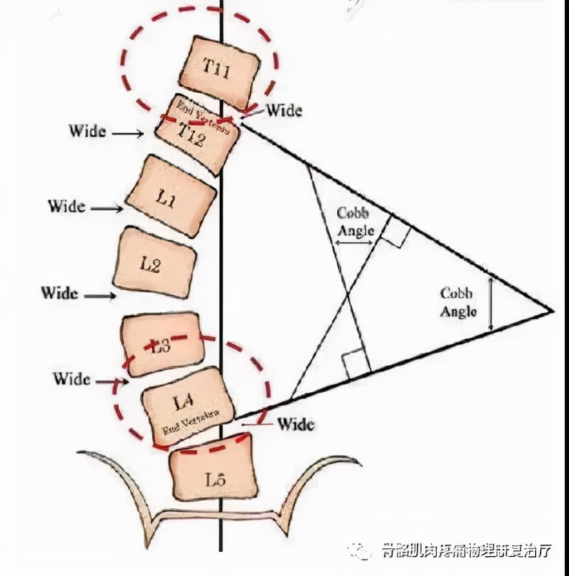 脊柱侧弯23度施罗斯矫正有用吗,非结构性脊柱侧弯