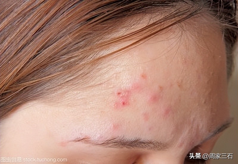 疮毒治疗中成药,治疗疮疡的用药