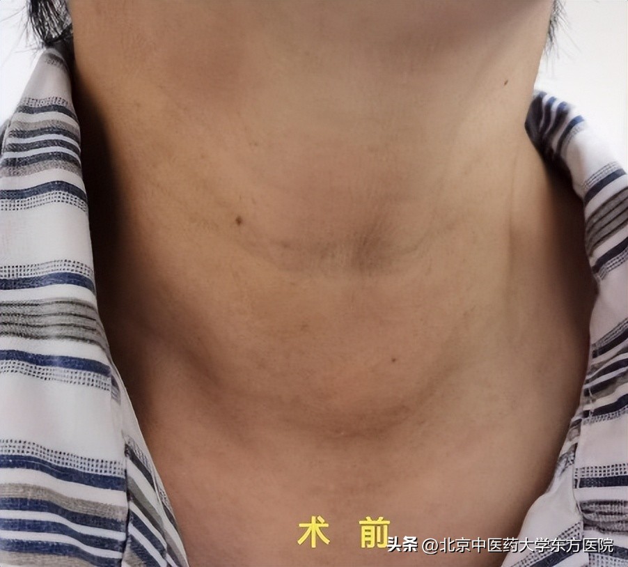 甲状腺手术不留疤痕的方法,甲状腺手术三年疤痕增生会疼吗