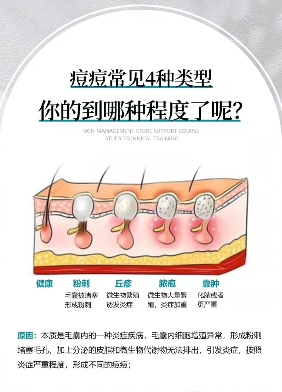 痘痘的几种类型以及解决办法,各种类型的痘痘以及处理方法