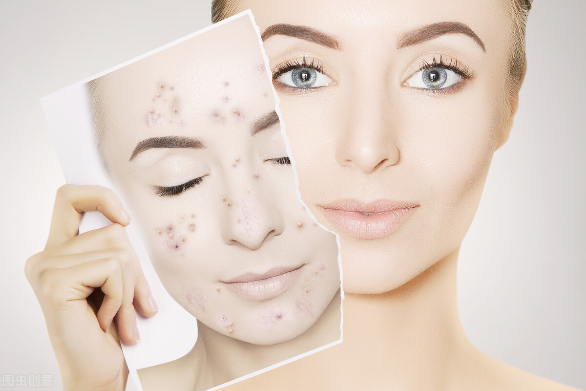 痘痘到底能不能挤呢,痘痘到底能不能挤掉