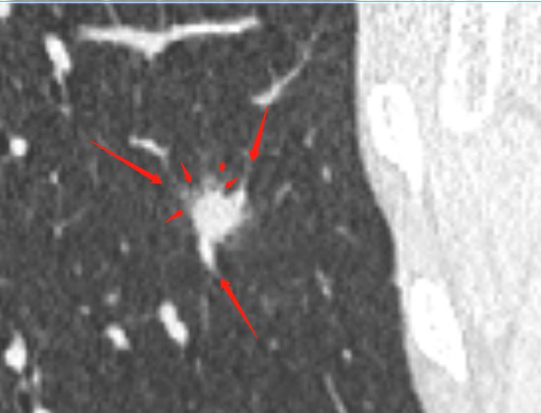 肺结节进一步检查排除肿瘤,肺结节4mm报告建议复查