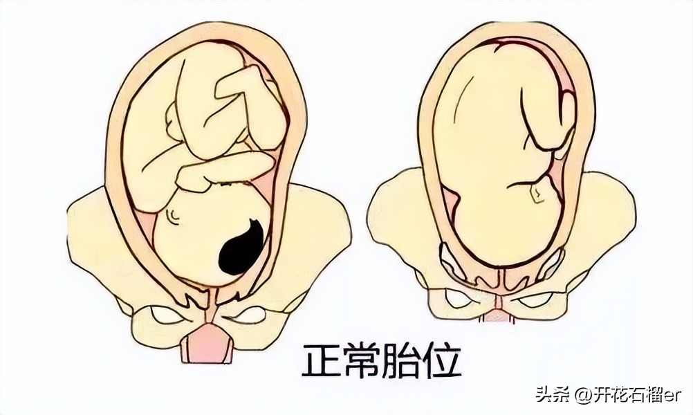 仰头和低头出生的区别,婴儿仰头出生和侧身出生