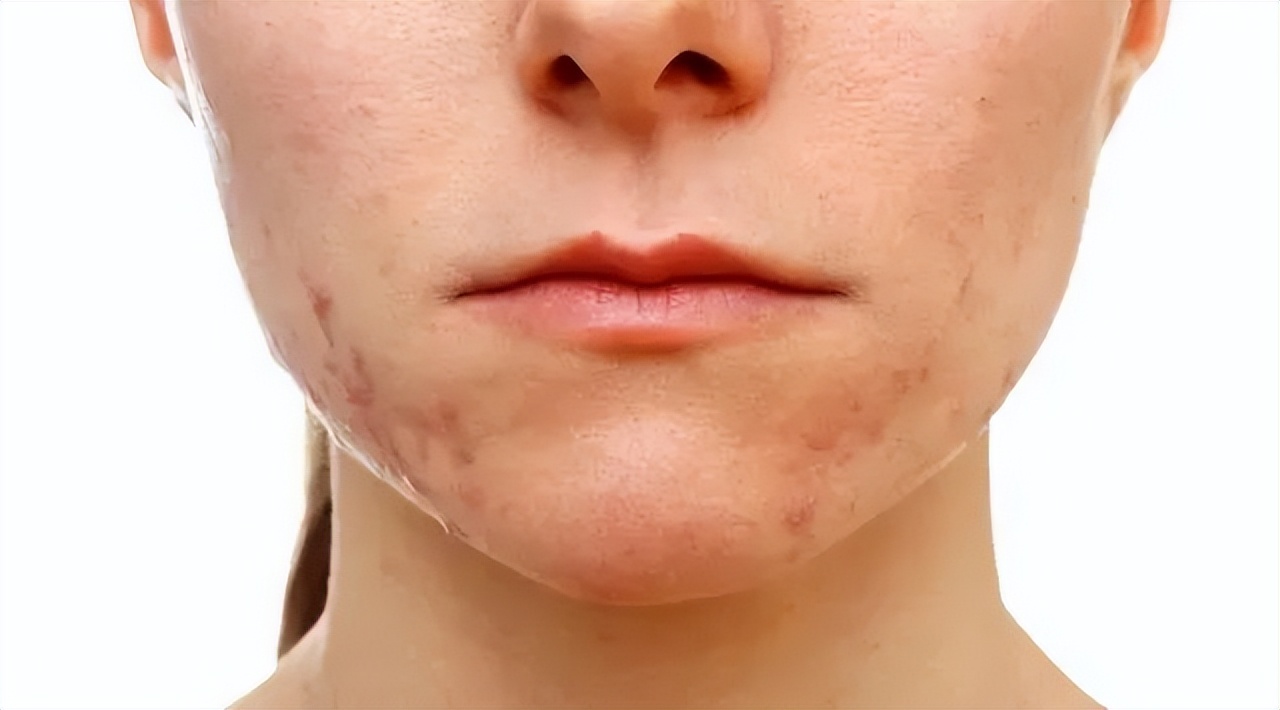 祛痘的十大误区你中招了吗,祛痘也有误区痘痘肌教你护理