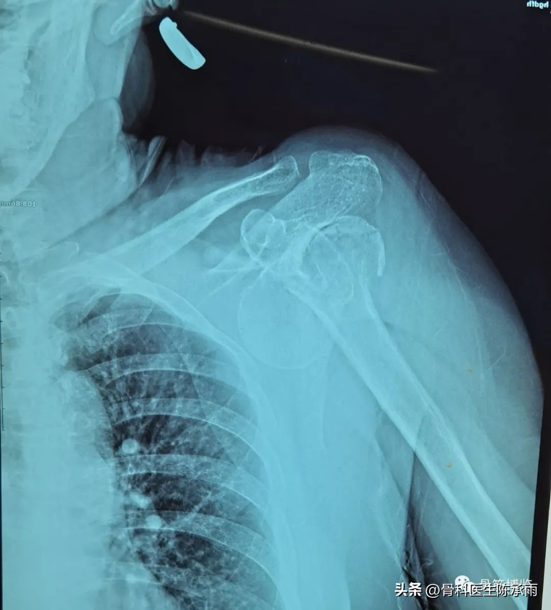 右肱骨外科颈骨折康复视频,肱骨颈骨折后并发症有哪些