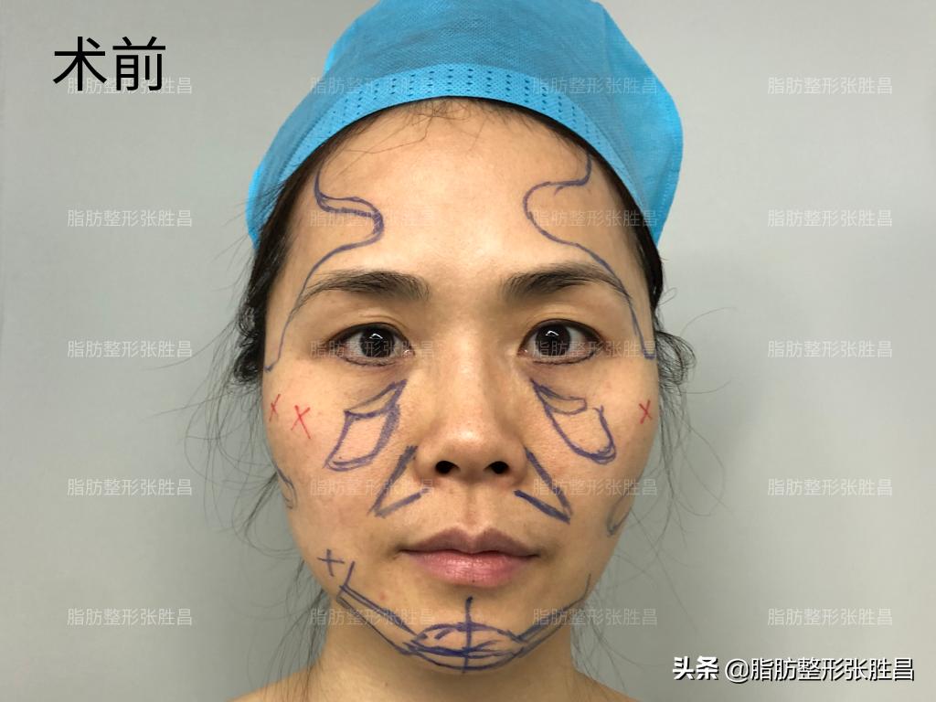 菱形脸颧骨突出怎么改善,颧骨高太阳穴凹陷全脸填充的效果