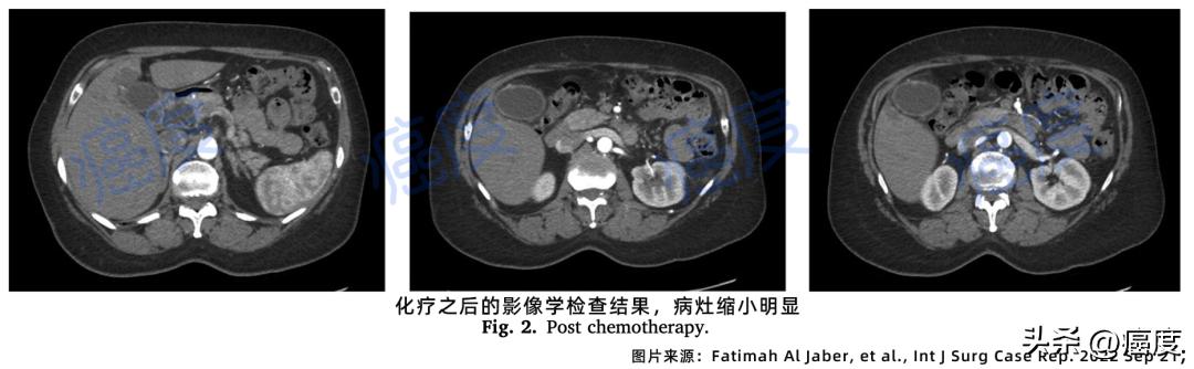 有效就是王道，晚期胆囊癌通过手术获得长期生存