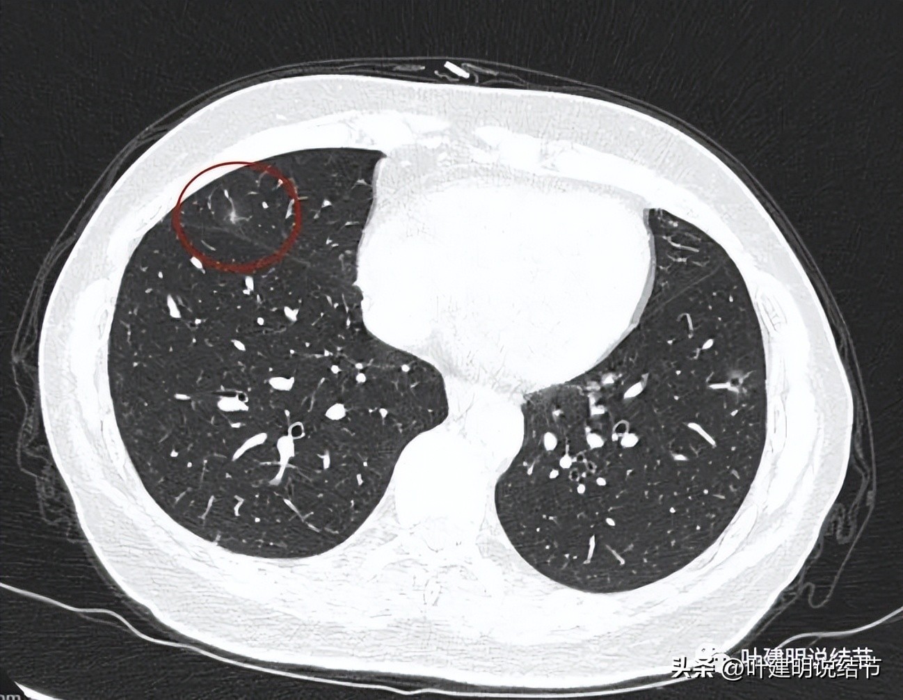 辽宁省肺结节手术哪家医院好,辽宁肺结节手术医院