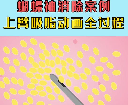 瘦手臂最快的方法吸脂,吸脂瘦手臂前后对比图