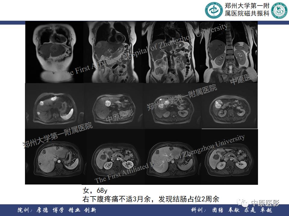 肝脏血管瘤样本,正确认识肝脏血管瘤文章