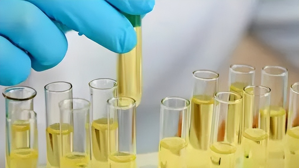 教您轻松解读化验单之尿常规,尿常规化验单粘液丝解读