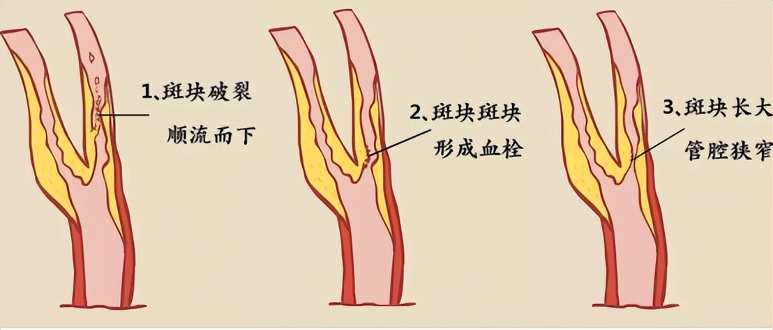 脑梗颈动脉斑块90%能治愈吗,有颈动脉斑块需要服他汀药吗