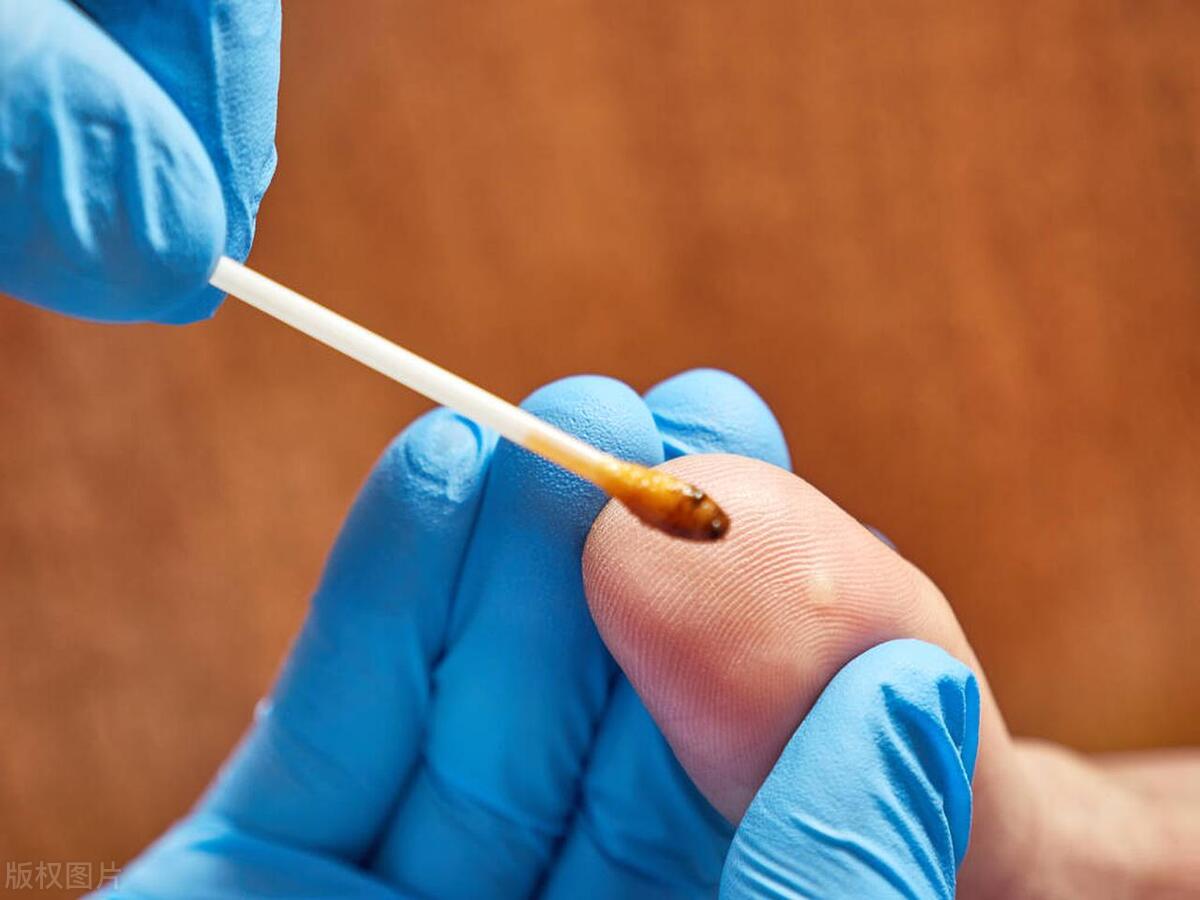 处理身上瘊子的方法,身上有瘊子怎么根除