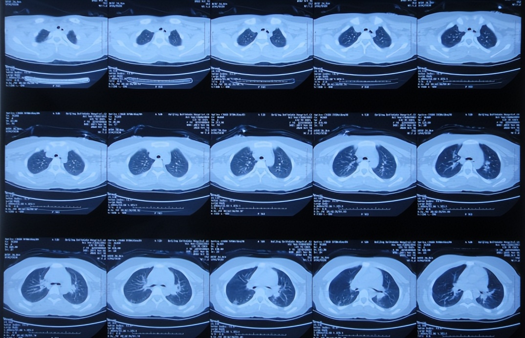 脑干出血儿童,儿童脑干胶质瘤呕吐