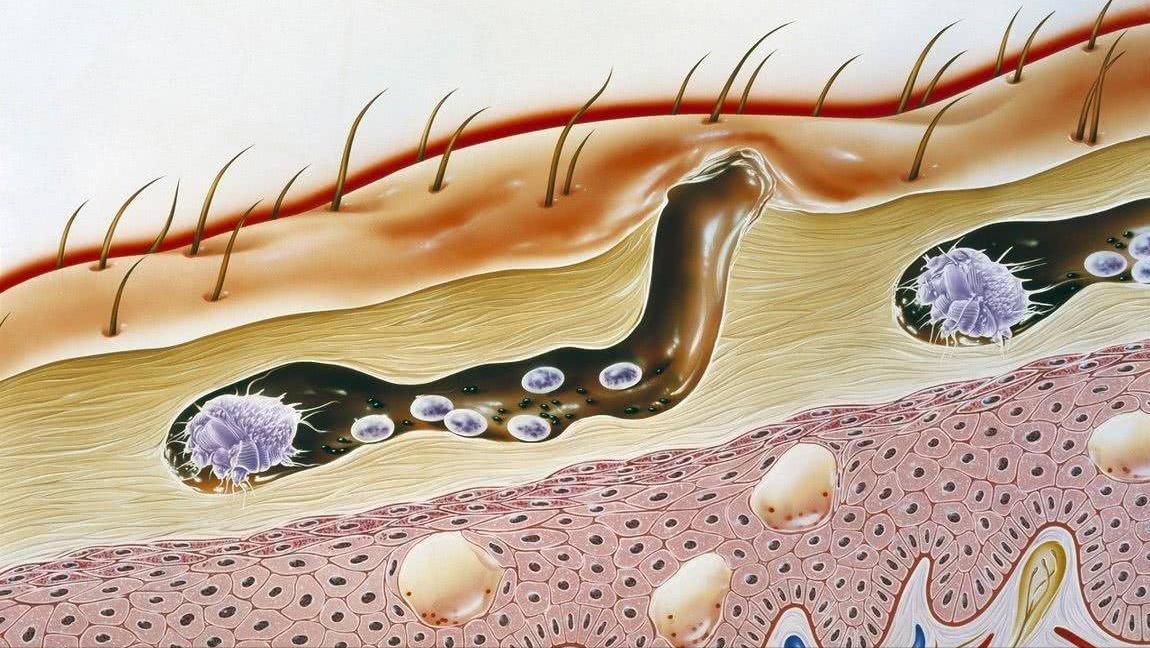 脖子下面长痘痘是什么原因,脸下面长痘痘是什么原因