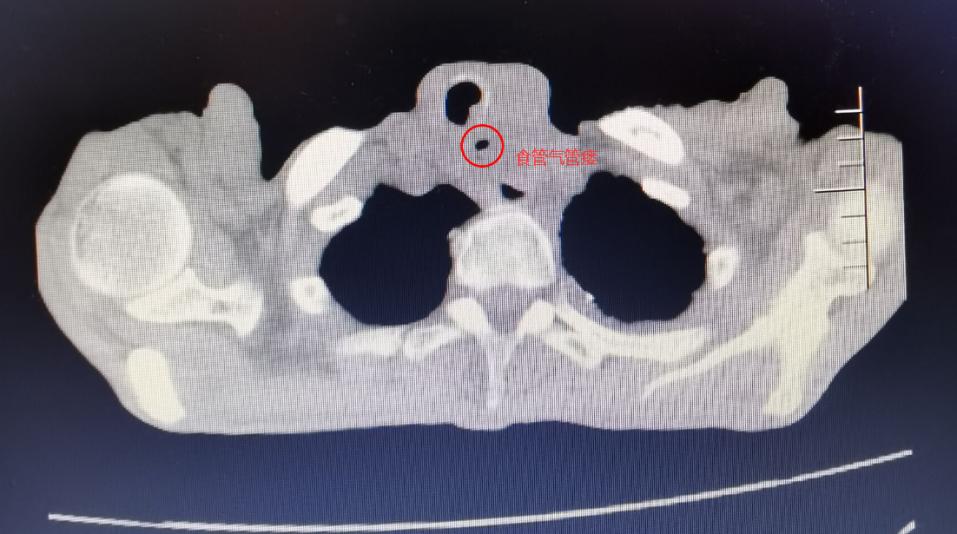 食管癌气管瘘案例,食管癌并发吻合口瘘的案例介绍