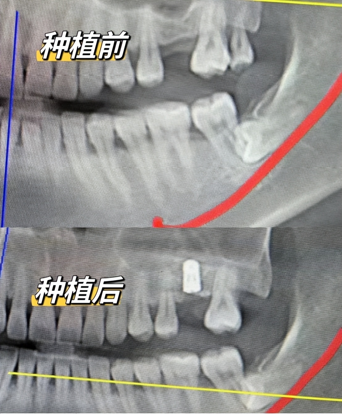 种植牙怎么注意口腔卫生,种植牙如何保养才能用的时间最长