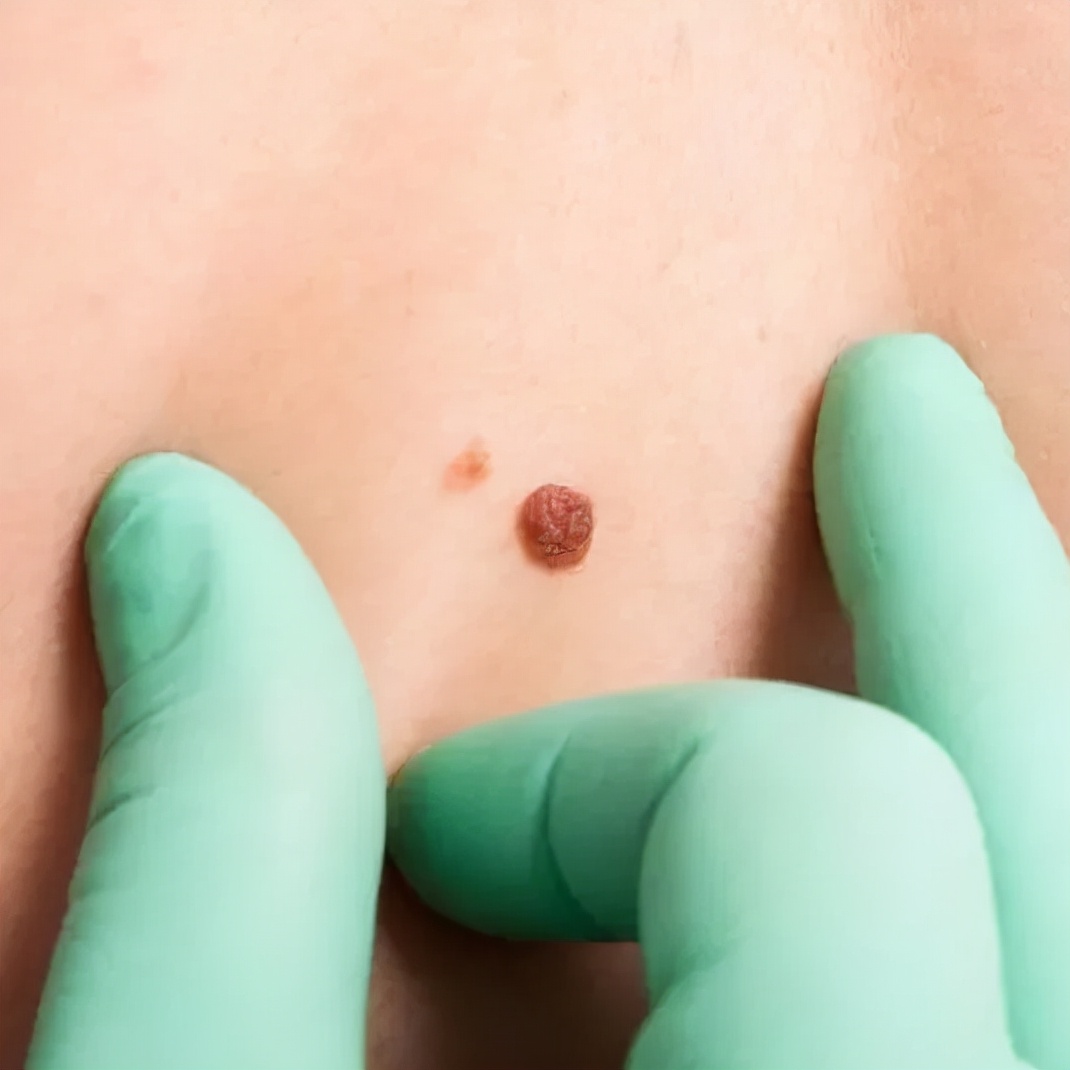 如何区别黑痣和黑色素瘤,怎样区别黑痣和黑色素瘤