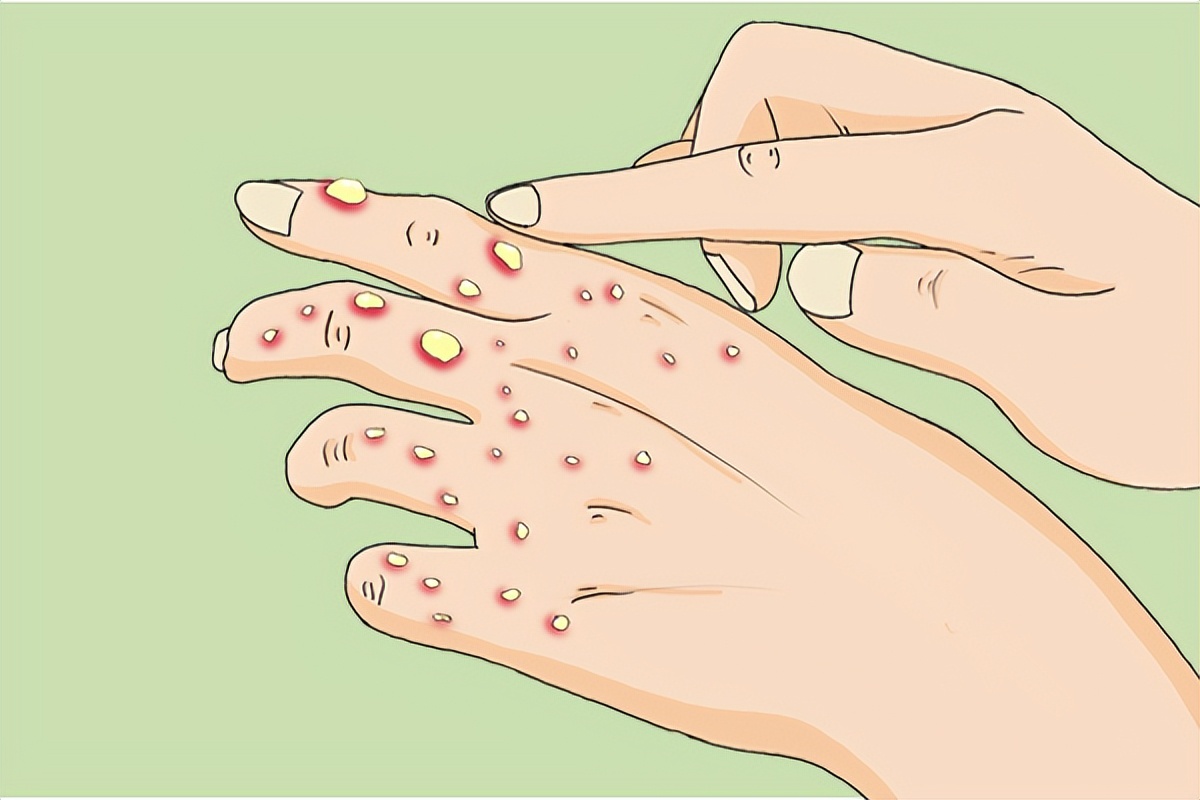 全球确诊38例猴痘病例,美国猴痘确诊病例数居全球首位