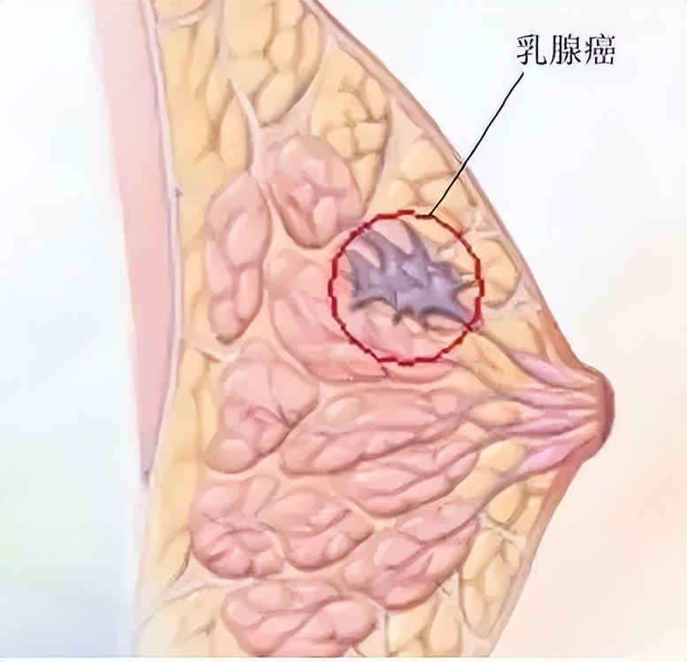 雌激素对乳腺癌影响几何？孕激素呢？