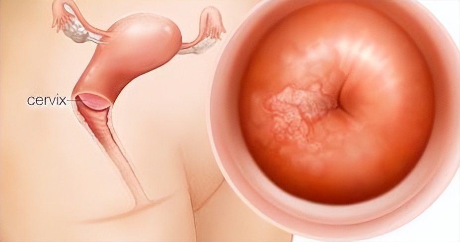 一年间体检查出宫颈癌是晚期,20岁宫颈癌是什么原因引起的