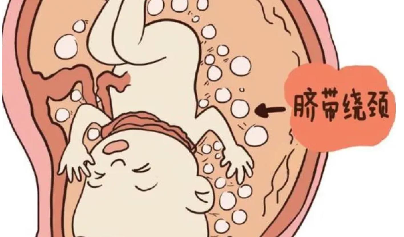 33周胎儿脐带绕颈一周能绕回来吗,胎儿脐带绕颈的原因和解决方法