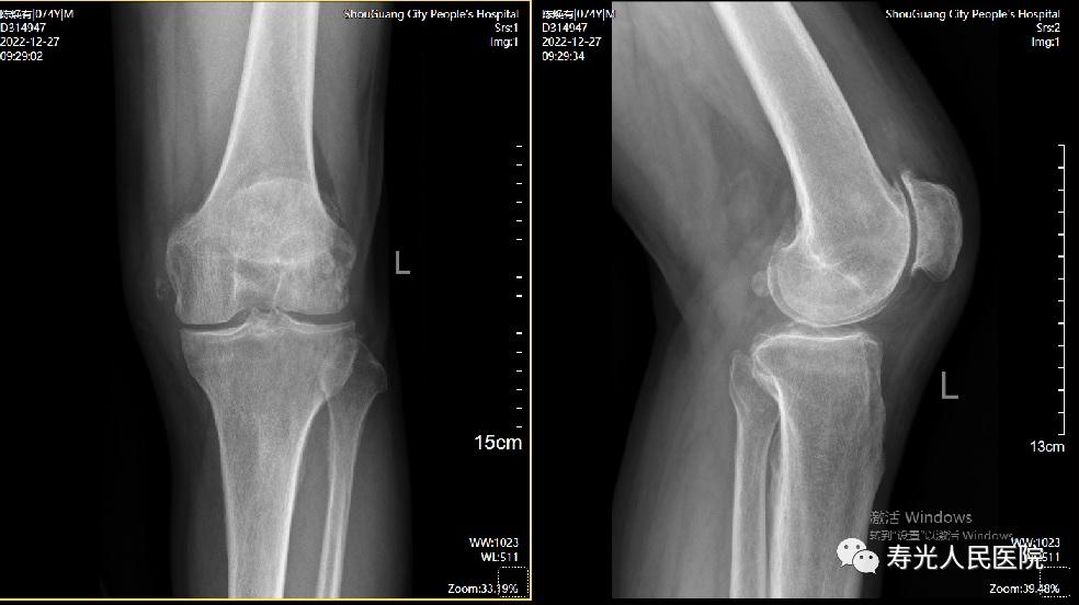 从云南到寿光，跨越四千里的信任丨一云南患者来寿光市人民医院关节创伤外科进行膝关节治疗